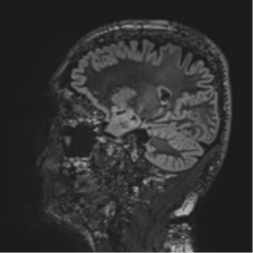 Normal brain MRI (non-focal epilepsy protocol) (Radiopaedia 53917-60040 Sagittal DIR 25).png