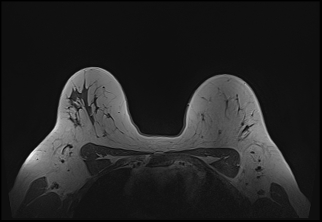 File:Normal breast MRI - dense breasts (Radiopaedia 80454-93850 Axial T1 166).jpg