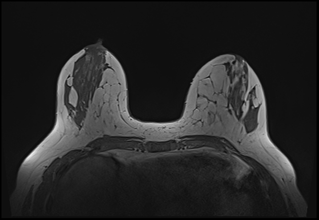 File:Normal breast MRI - dense breasts (Radiopaedia 80454-93850 Axial T1 80).jpg
