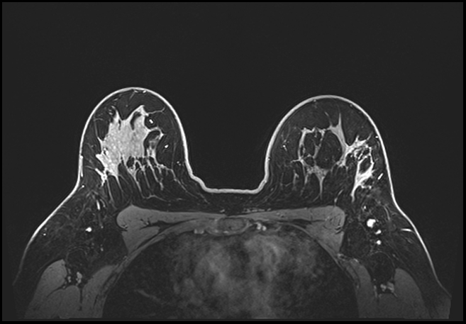 Normal breast MRI - dense breasts (Radiopaedia 80454-93850 C 155).jpg
