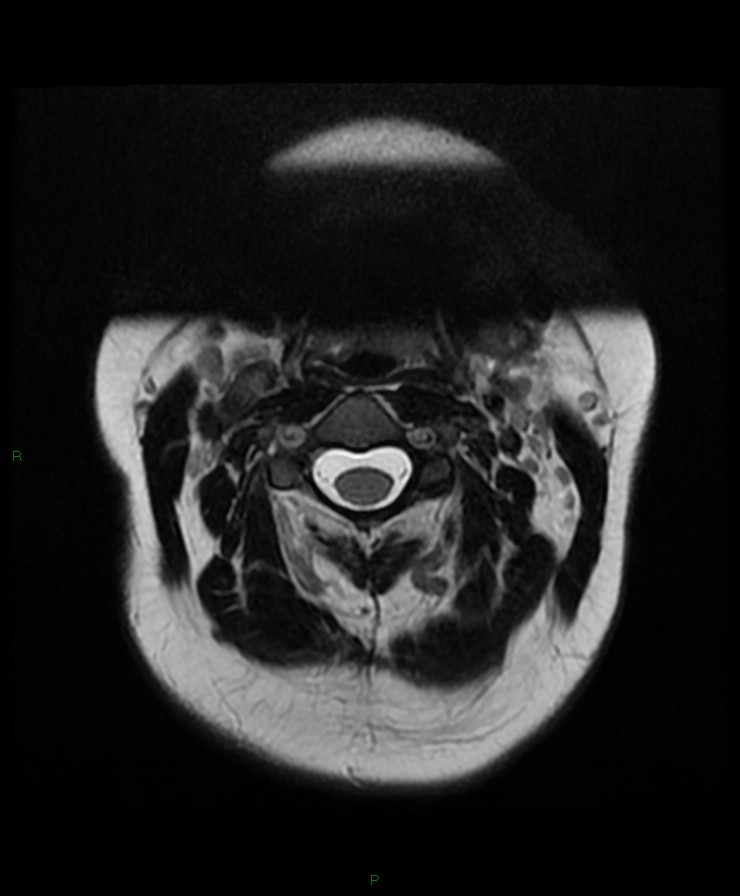 Normal cervical spine MRI (Radiopaedia 80146-93454 Axial T2 19).jpg