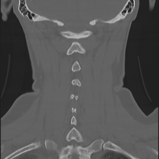 File:Normal cervical spine MRI (including Dixon) (Radiopaedia 42762-45926 Axial bone window 1).png