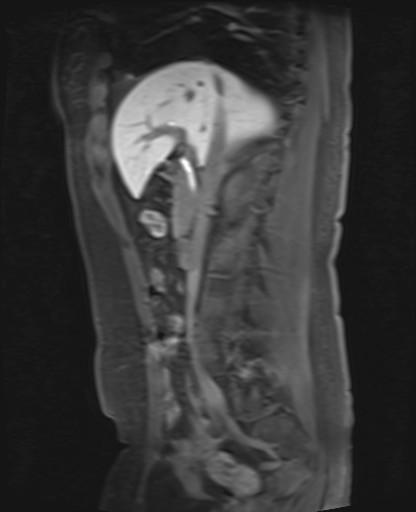 File:Normal hepatobiliary phase liver MRI (Radiopaedia 58968-66230 C 33).jpg