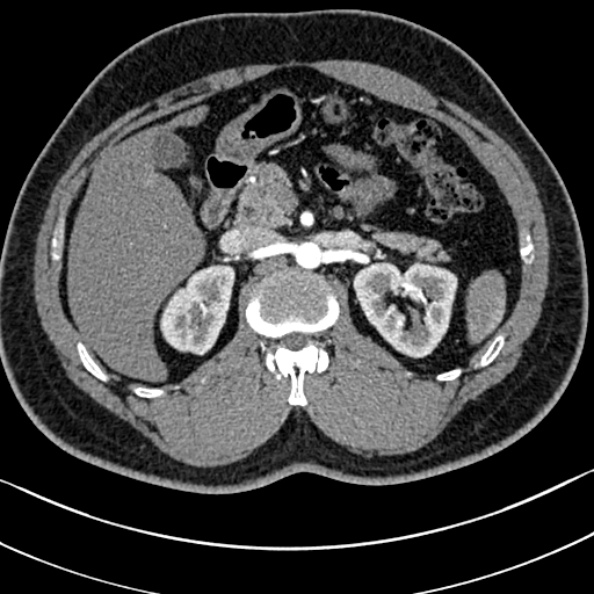 Normal kidneys on 4-phase CT study (Radiopaedia 25889-26038 B 24).jpg