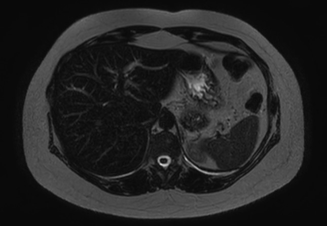 File:Normal liver MRI with Gadolinium (Radiopaedia 58913-66163 E 23).jpg