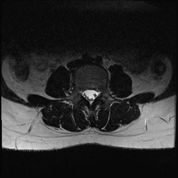 File:Normal lumbar spine MRI- 3 T (Radiopaedia 53280-59250 Axial T2 13).jpg