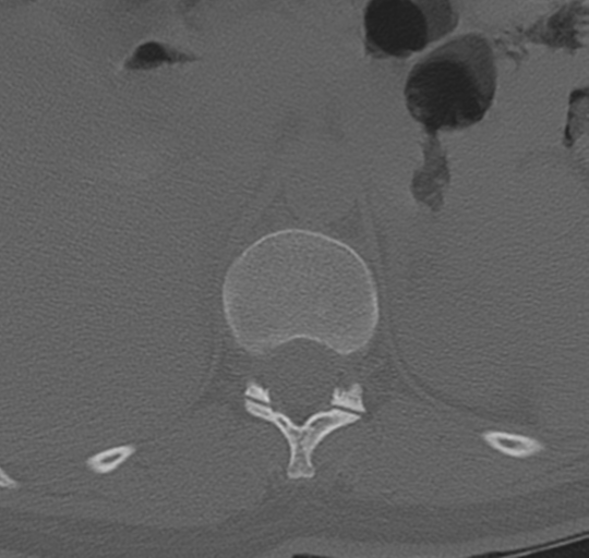 File:Normal lumbosacral CT (Radiopaedia 37923-39867 Axial bone window 17).png