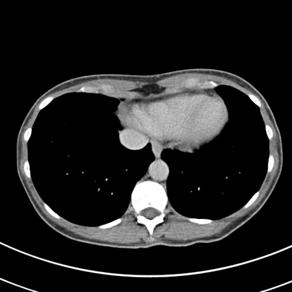 File:Normal multiphase CT liver (Radiopaedia 38026-39996 Axial C+ delayed 1).jpg