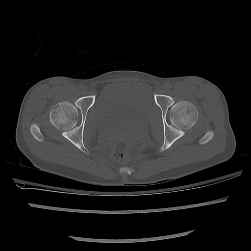 Normal pelvis CT (Radiopaedia 51471-57236 Axial bone window 75).jpg
