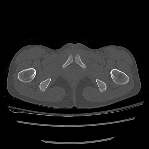 Normal pelvis CT (Radiopaedia 51471-57236 Axial bone window 93).jpg