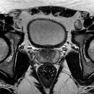 File:Normal prostate (MRI) (Radiopaedia 29986-30535 Axial T2 13).jpg