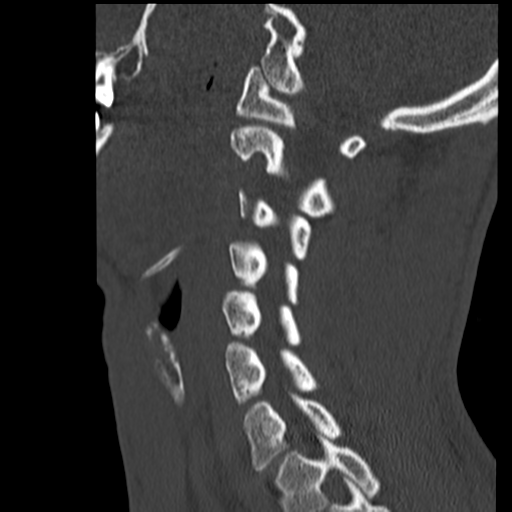 File:Normal trauma cervical spine (Radiopaedia 41017-43760 Sagittal bone window 31).png