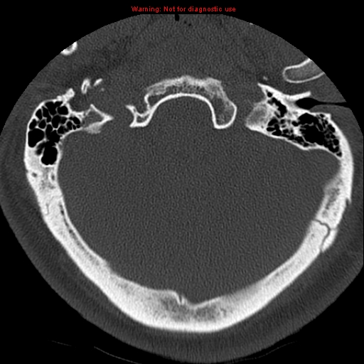 File:Occipital condyle fracture (Radiopaedia 18366-18208 Axial bone window 4).jpg