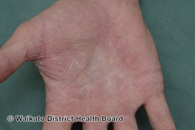 File:Palmar dermatitis (DermNet NZ irritant-contact-dermatitis-001).jpg