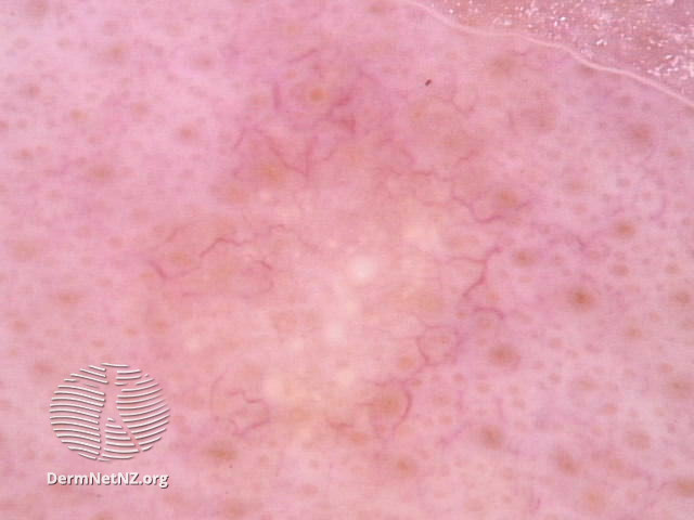 File:Trichoepithelioma dermoscopy (DermNet NZ doctors-dermoscopy-course-images-trichoepithelioma1).jpg