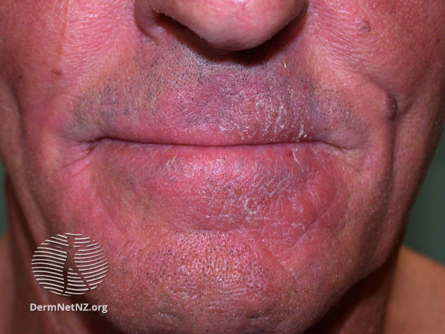 File:(DermNet NZ dermatitis-acd-face-2432).jpg