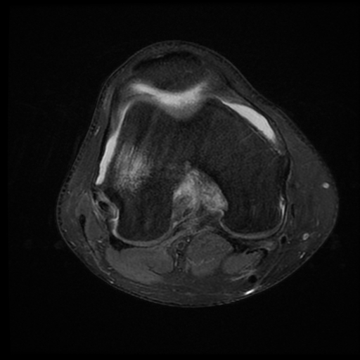 File:ACL acute full thickness tear - deep lateral femoral sulcus sign (Radiopaedia 38594-40740 Axial PD fat sat 13).jpg