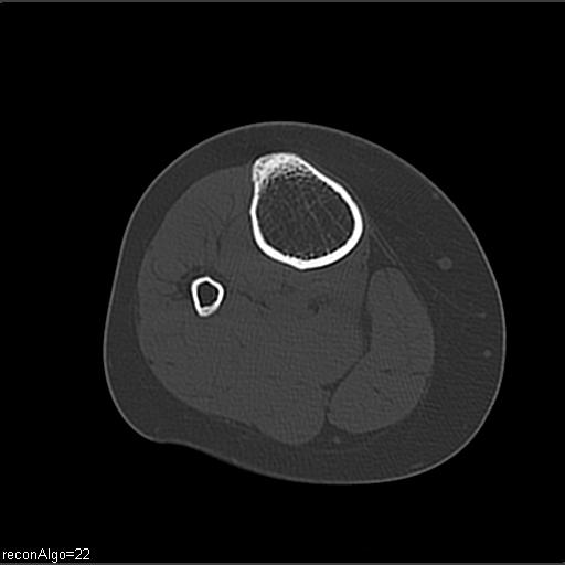 File:ACL avulsion fracture (Radiopaedia 33833-34994 Axial bone window 27).jpg