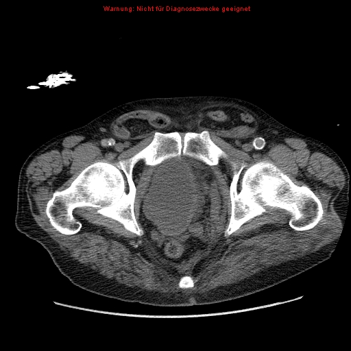 Abdominal aortic aneurysm- extremely large, ruptured (Radiopaedia 19882-19921 Axial C+ arterial phase 77).jpg