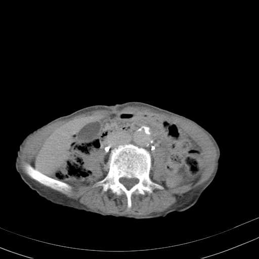 File:Abdominal aortic aneurysm (Radiopaedia 20827-20742 Axial C+ delayed 18).jpg