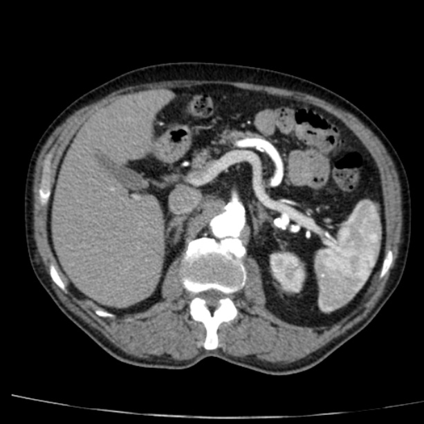 Abdominal aortic aneurysm (Radiopaedia 29248-29660 Axial C+ arterial phase 27).jpg