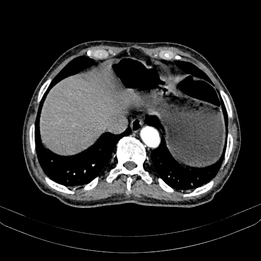 Abdominal aortic aneurysm (Radiopaedia 83581-98689 Axial C+ arterial phase 17).jpg