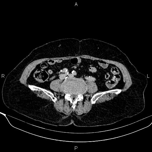 Abdominal aortic aneurysm (Radiopaedia 85063-100606 Axial C+ delayed 89).jpg