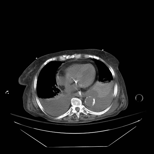 Abdominal aortic aneurysm - impending rupture (Radiopaedia 19233-19247 Axial non-contrast 19).jpg