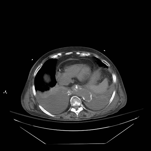 File:Abdominal aortic aneurysm - impending rupture (Radiopaedia 19233-19247 Axial non-contrast 26).jpg