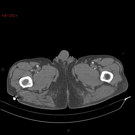 Abdominal aortic aneurysm rupture with aortocaval fistula (Radiopaedia 14897-14841 Axial C+ arterial phase 141).jpg