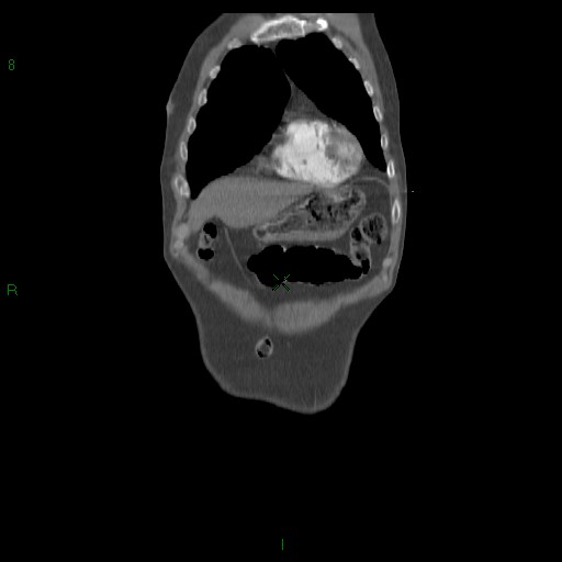 File:Abdominal aortic aneurysm rupture with aortocaval fistula (Radiopaedia 14897-14841 Coronal C+ arterial phase 15).jpg