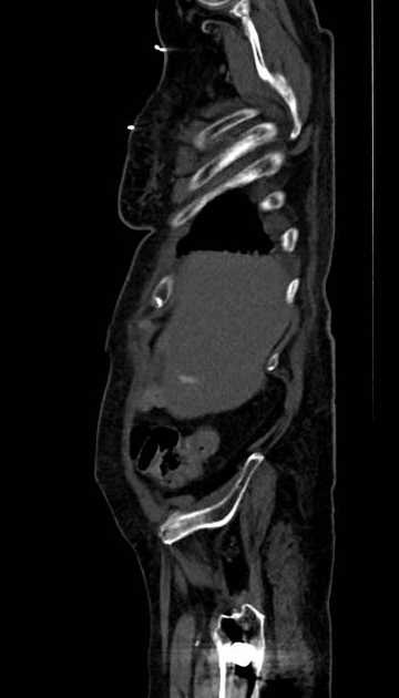 Abdominal aortic aneurysm with thrombus fissuration (Radiopaedia 73192-83919 Sagittal C+ arterial phase 127).jpg