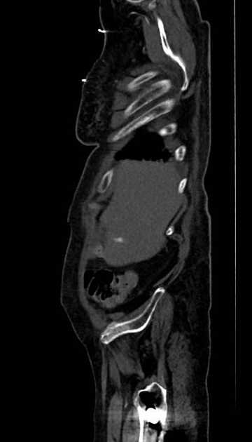 Abdominal aortic aneurysm with thrombus fissuration (Radiopaedia 73192-83919 Sagittal C+ arterial phase 128).jpg