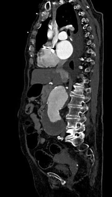Abdominal aortic aneurysm with thrombus fissuration (Radiopaedia 73192-83919 Sagittal C+ arterial phase 78).jpg