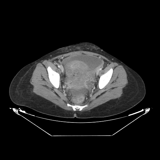 Abdominal gossypiboma- surgical towel (Radiopaedia 57288-64226 Axial C+ portal venous phase 66).jpg