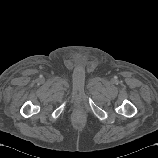Abdominal hematoma (Radiopaedia 33614-34715 Axial C+ portal venous phase 148).png