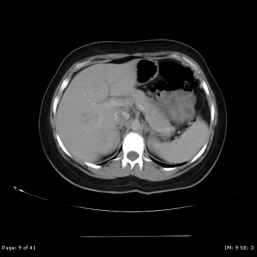File:Abdominal wall endometriosis (Radiopaedia 25723-25885 Axial C+ portal venous phase 9).jpg