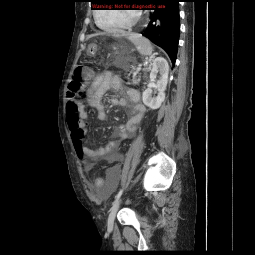 Abdominal wall hematoma (Radiopaedia 9427-10112 Sagittal C+ portal venous phase 34).jpg