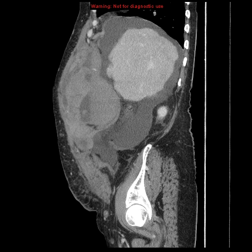 Abdominal wall hematoma (Radiopaedia 9427-10112 Sagittal C+ portal venous phase 82).jpg