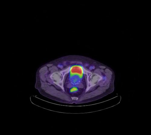 Abdominal wall metastasis from colorectal carcinoma (Radiopaedia 31016-31719 Axial 25).jpg