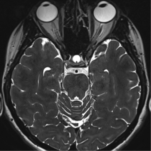 Abducens nerve palsy (Radiopaedia 51069-56648 Axial T2 fat sat 55).png