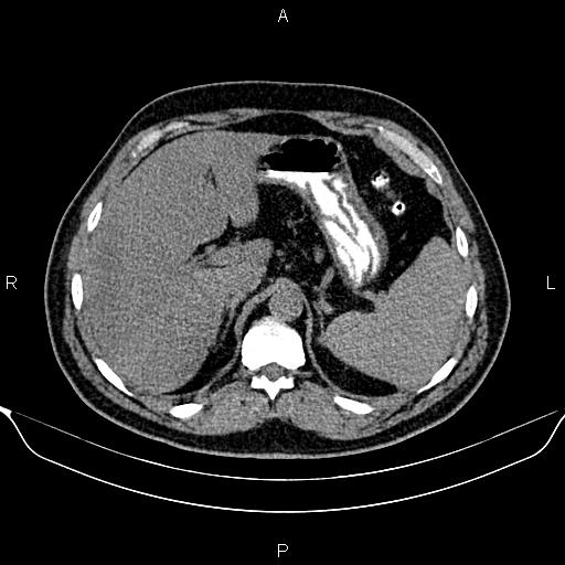 Aberrant right subclavian artery (Radiopaedia 87093-103354 Axial non-contrast 114).jpg