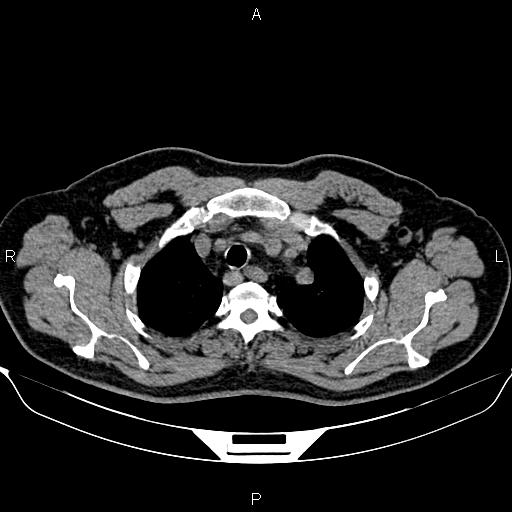 Aberrant right subclavian artery (Radiopaedia 87093-103354 Axial non-contrast 20).jpg
