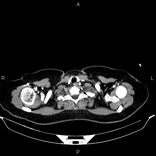 File:Aberrant right subclavian artery (Radiopaedia 87334-103629 Axial C+ arterial phase 6).jpg