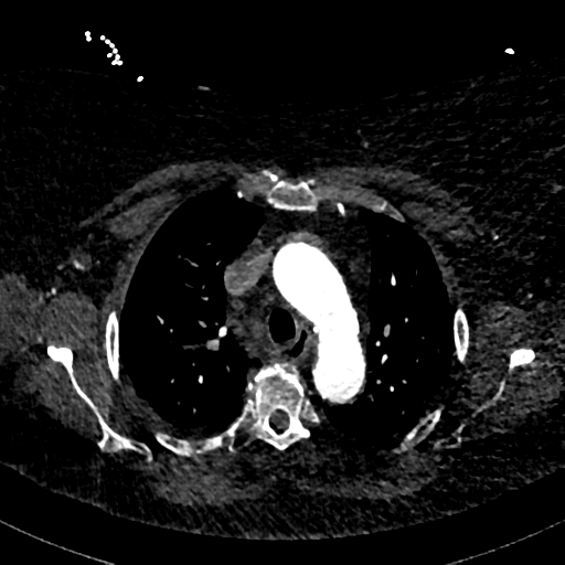 File:Aberrant right subclavian artery with Kommerell diverticulum (Radiopaedia 47982-52769 Axial C+ arterial phase 28).png