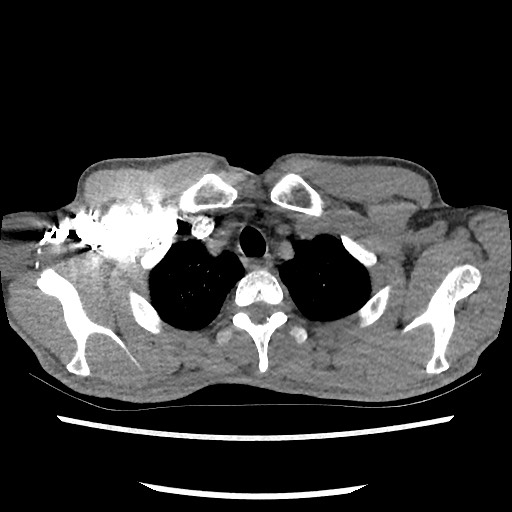 Accessory left horizontal fissure with lingular pneumonia (Radiopaedia 53763-59843 Axial C+ CTPA 14).jpg