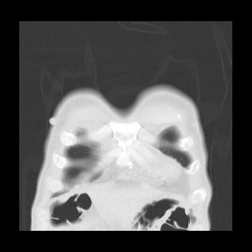 Accessory left horizontal fissure with lingular pneumonia (Radiopaedia 53763-59843 Coronal lung window 6).jpg