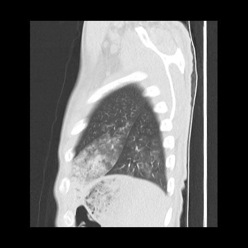 Accessory left horizontal fissure with lingular pneumonia (Radiopaedia 53763-59843 Sagittal lung window 59).jpg