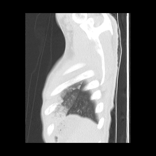 Accessory left horizontal fissure with lingular pneumonia (Radiopaedia 53763-59843 Sagittal lung window 62).jpg