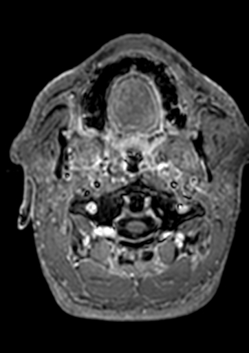 File:Accessory middle cerebral artery (Radiopaedia 73114-83828 Axial T1 C+ 217).jpg
